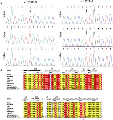 Typical pantothenate kinase-associated neurodegeneration caused by compound heterozygous mutations in PANK2 gene in a Chinese patient: a case report and literature review